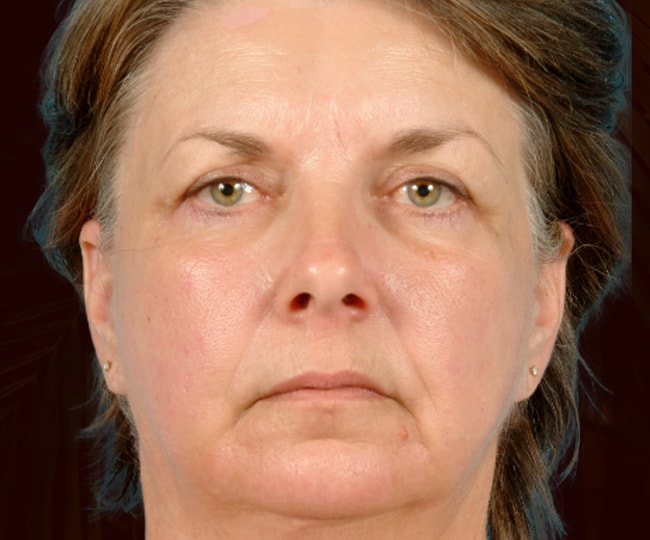 After - Blepharoplasty before and after - Patient 1