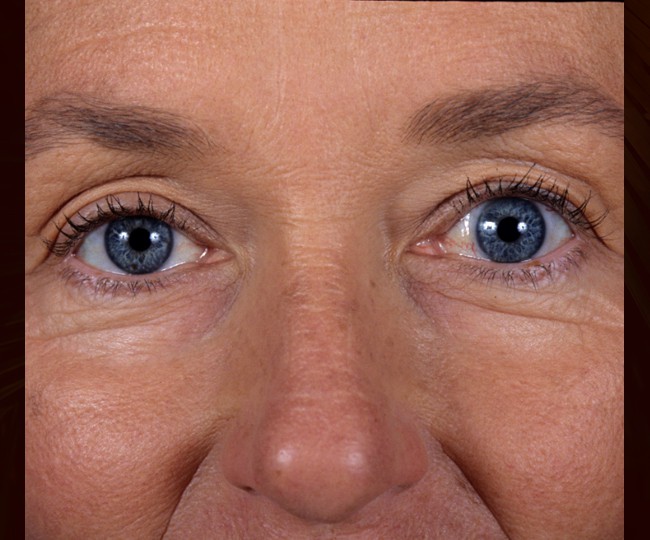 After - Blepharoplasty before and after - Patient 2
