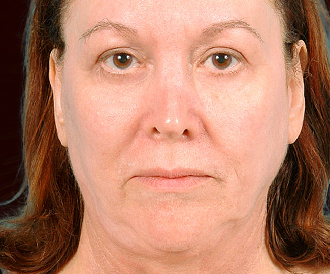 After - Blepharoplasty before and after - Patient 3