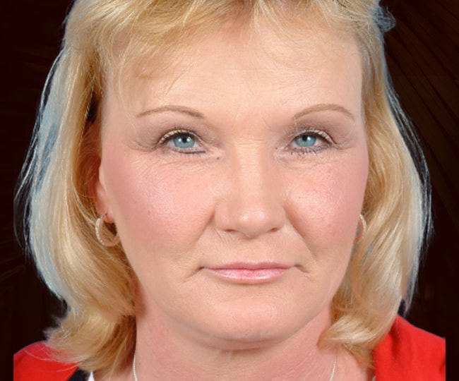 After - Blepharoplasty before and after - Patient 4