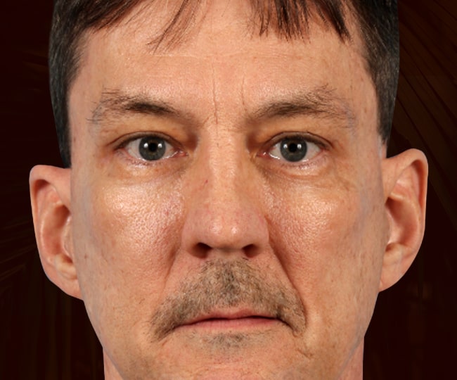 After - Blepharoplasty before and after - Patient 6