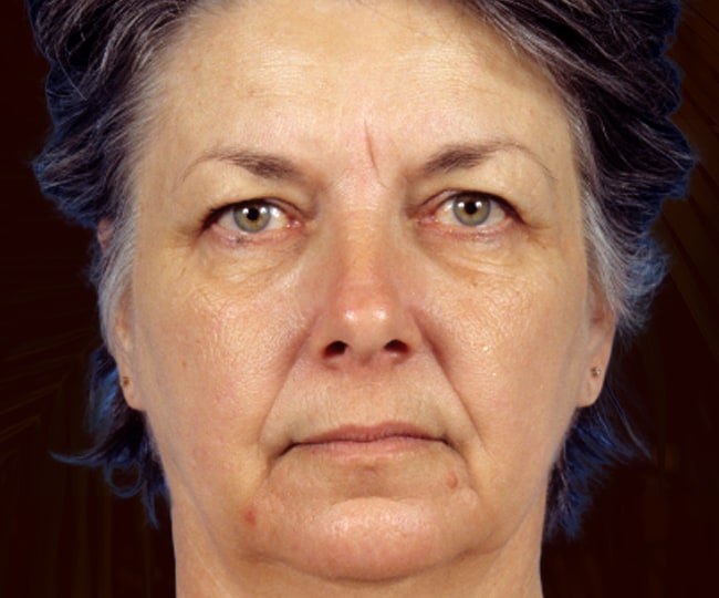 Before - Blepharoplasty before and after - Patient 1