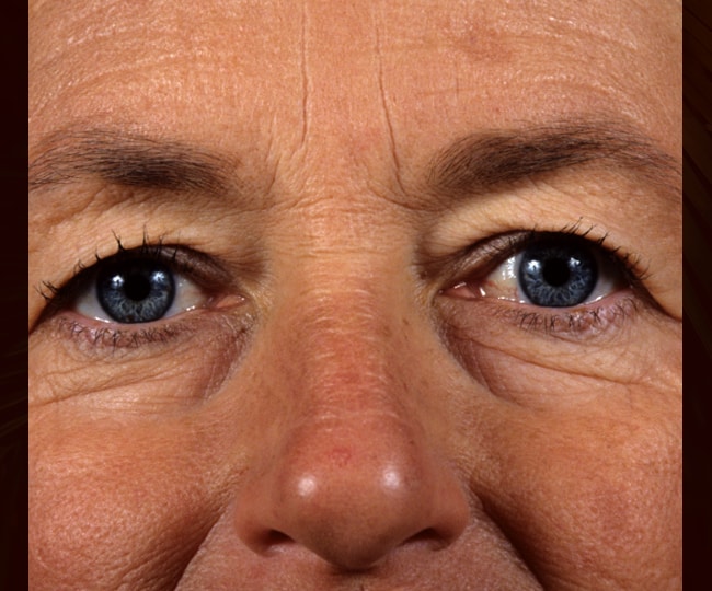 Before - Blepharoplasty before and after - Patient 2