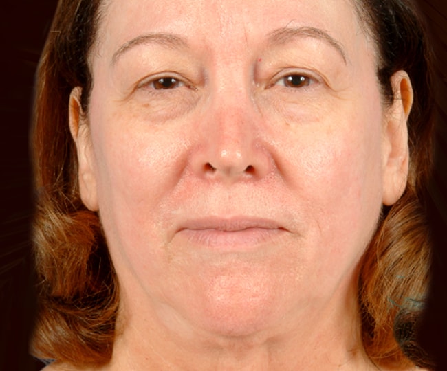 Before - Blepharoplasty before and after - Patient 3
