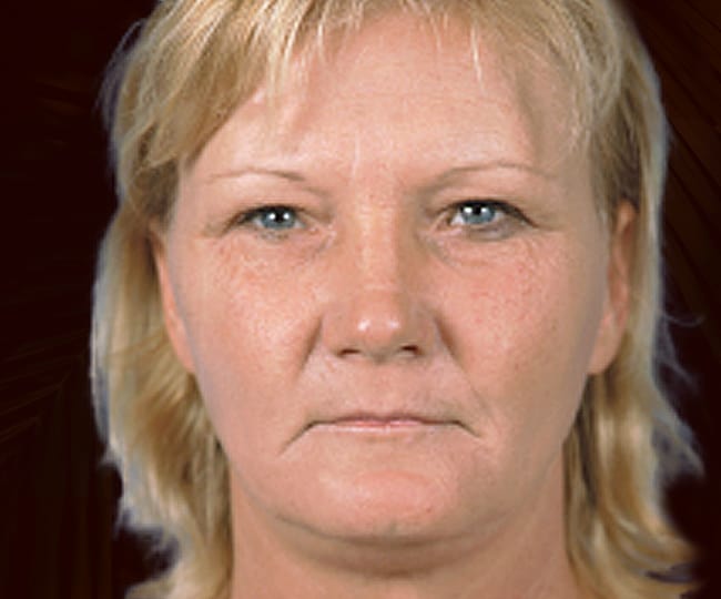 Before - Blepharoplasty before and after - Patient 4