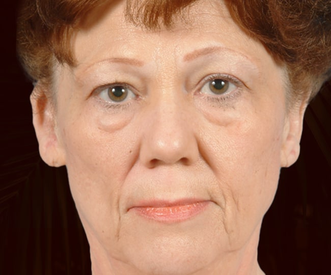 Before - Blepharoplasty before and after - Patient 5