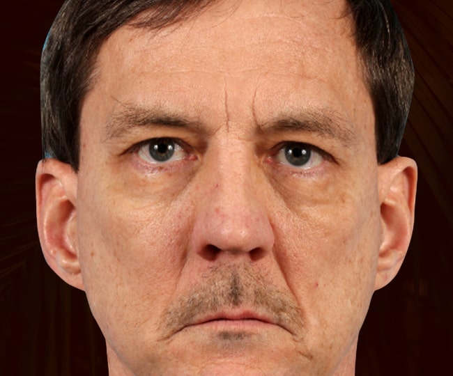 Before - Blepharoplasty before and after - Patient 6