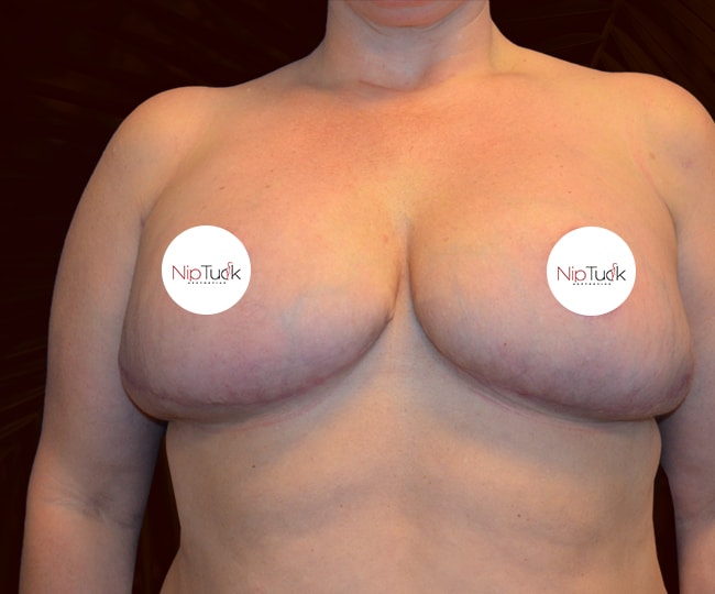 After - Breast reduction before and after - Patient 1