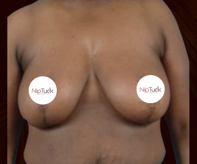 After - Breast reduction before and after - Patient 2