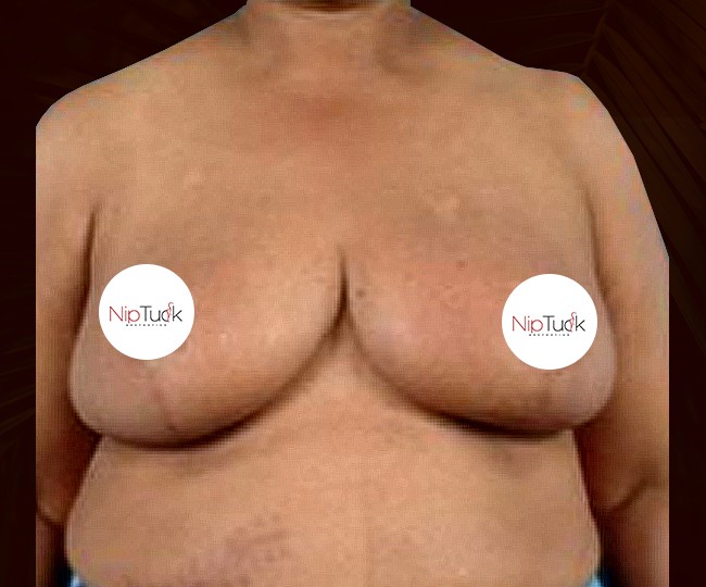After - Breast reduction before and after - Patient 3