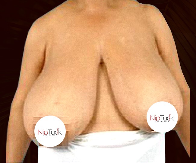 Before - Breast reduction before and after - Patient 3
