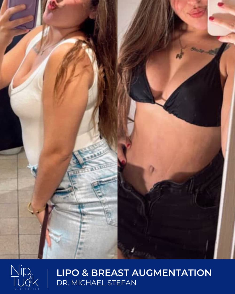 Breast augmentation results by Dr. Michael Stefan