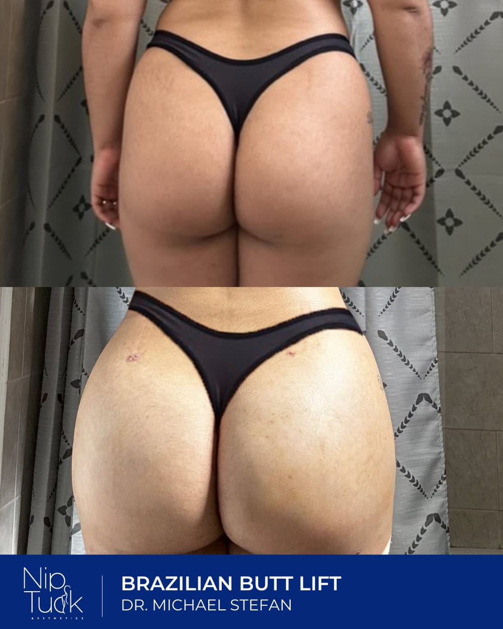 Brazilian butt lift results by Dr. Michael Stefan