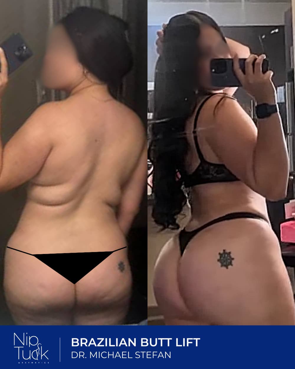 Brazilian butt lift results by Dr. Michael Stefan
