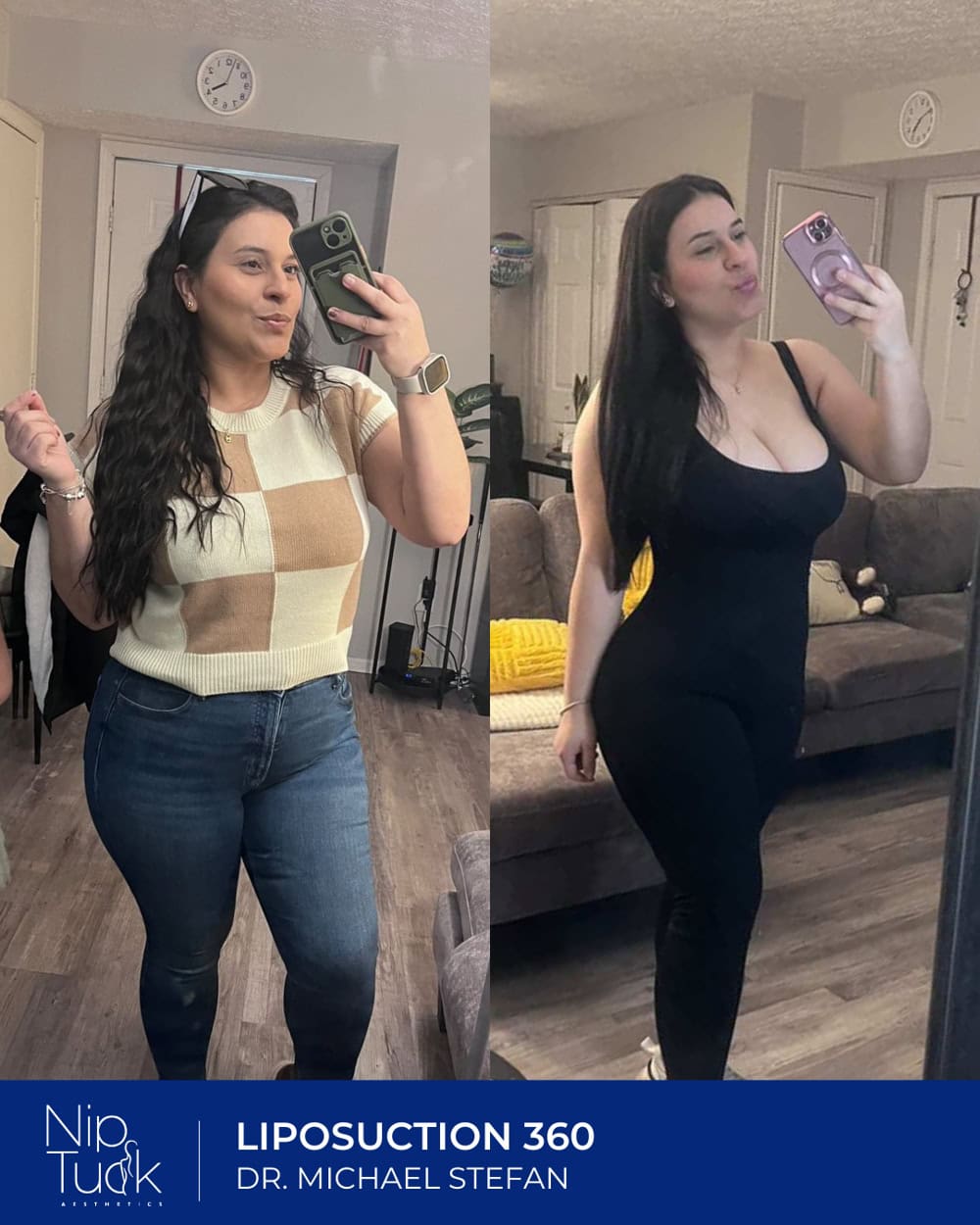 Liposuction results by Dr. Michael Stefan
