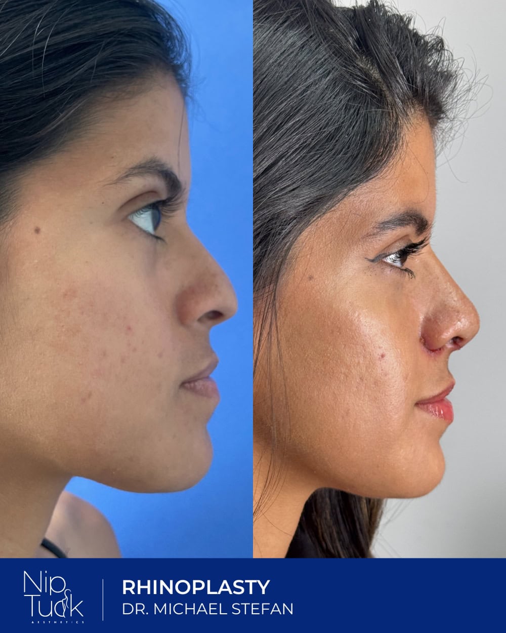 Rhinoplasty results by Dr. Michael Stefan