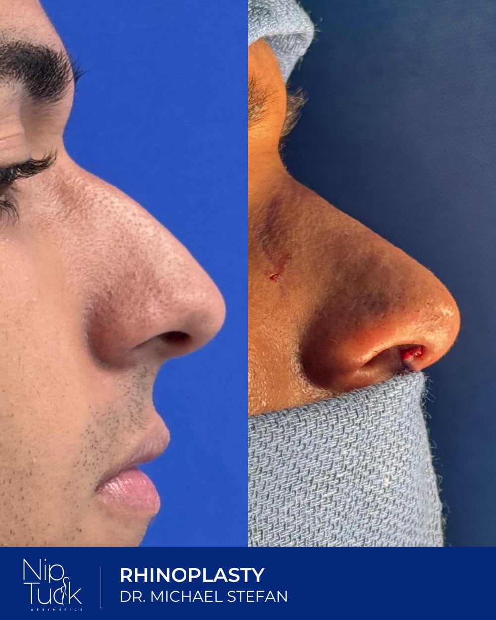 Rhinoplasty results by Dr. Michael Stefan
