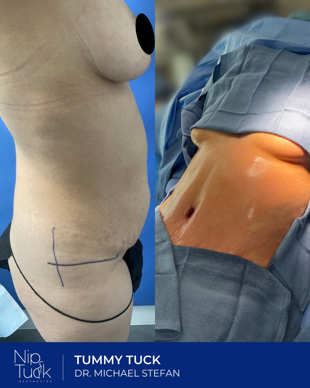 Tummy tuck results by Dr. Michael Stefan