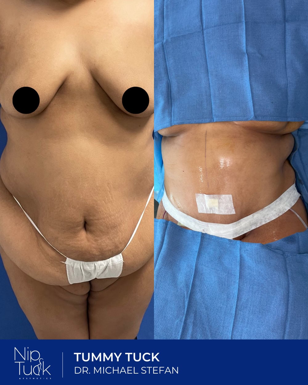 Tummy tuck results by Dr. Michael Stefan