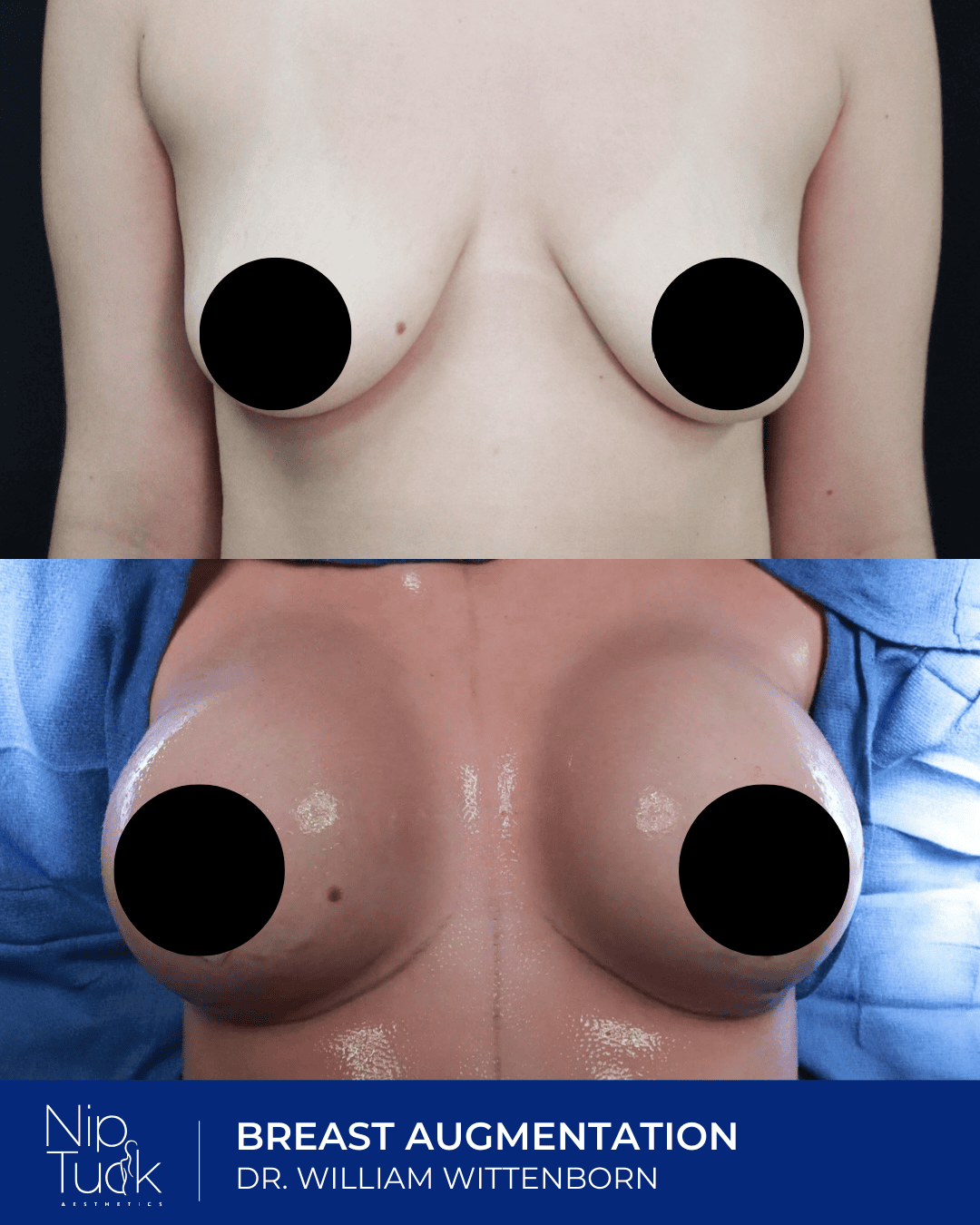 Breast augmentation results by Dr. Eric Wittenborn