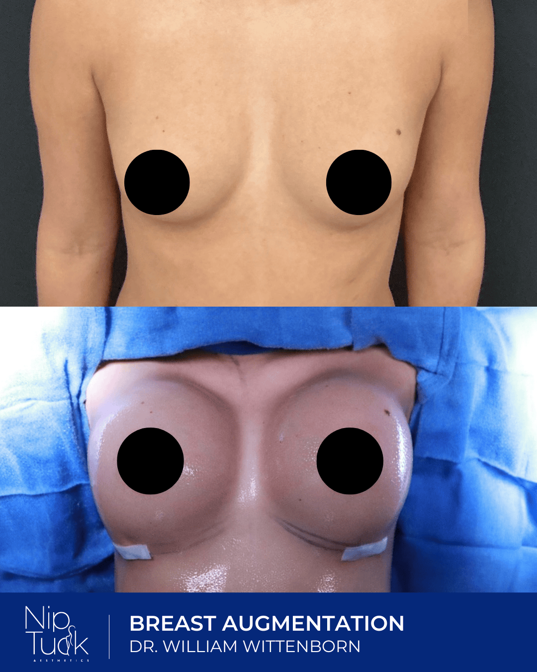 Breast augmentation results by Dr. Eric Wittenborn