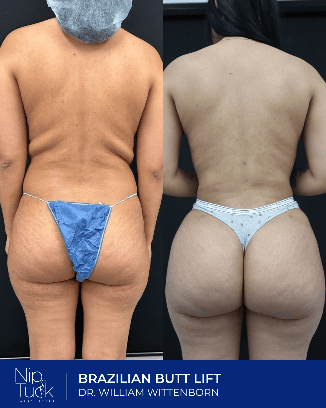 Brazilian butt lift results by Dr. Eric Wittenborn