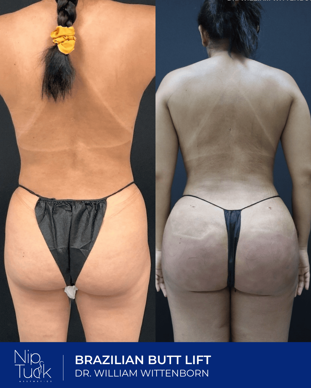 Brazilian butt lift results by Dr. Eric Wittenborn