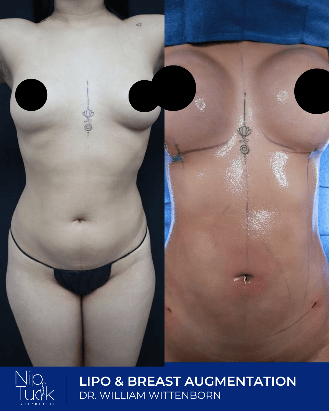 Liposuction results by Dr. Eric Wittenborn