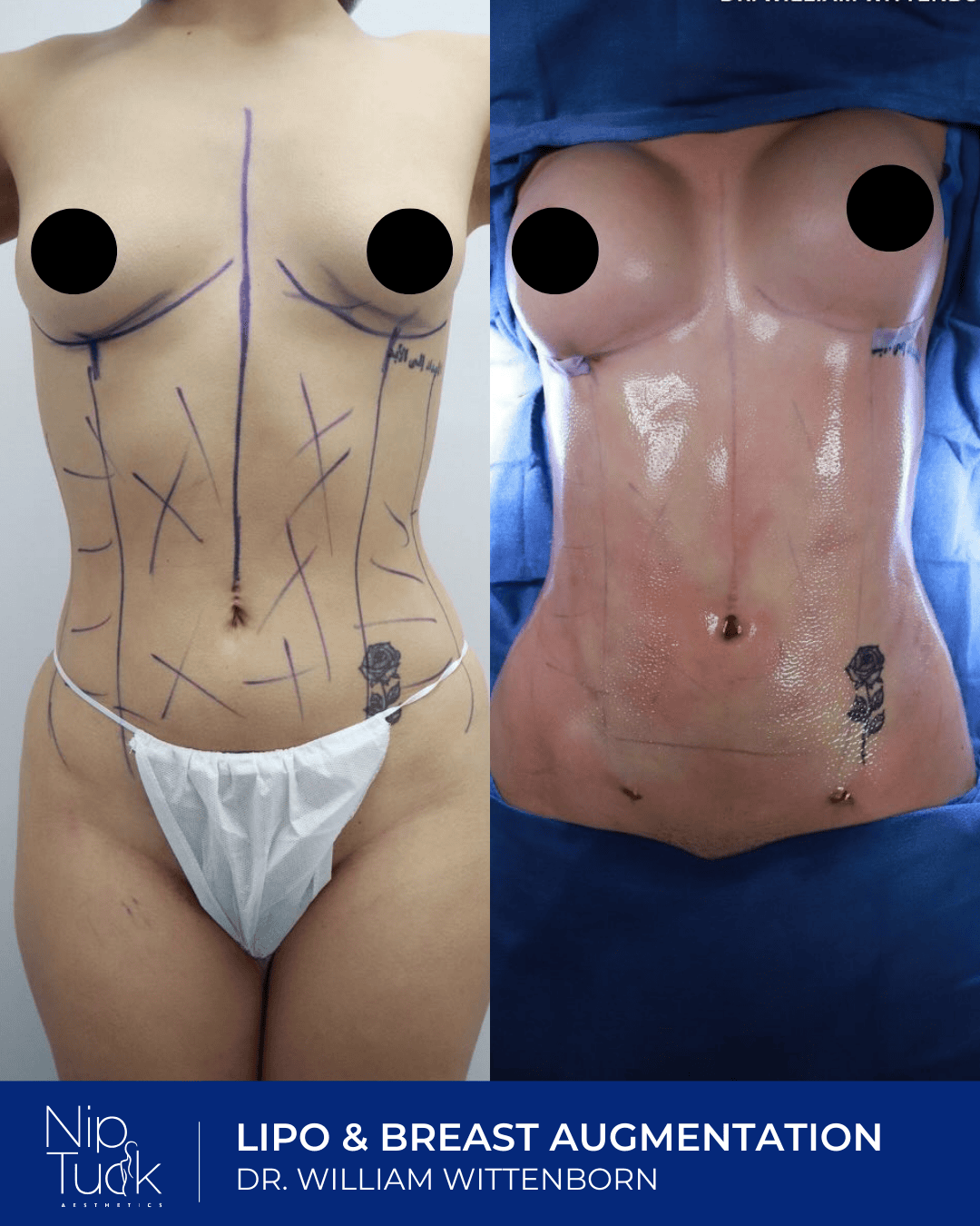 Liposuction results by Dr. Eric Wittenborn