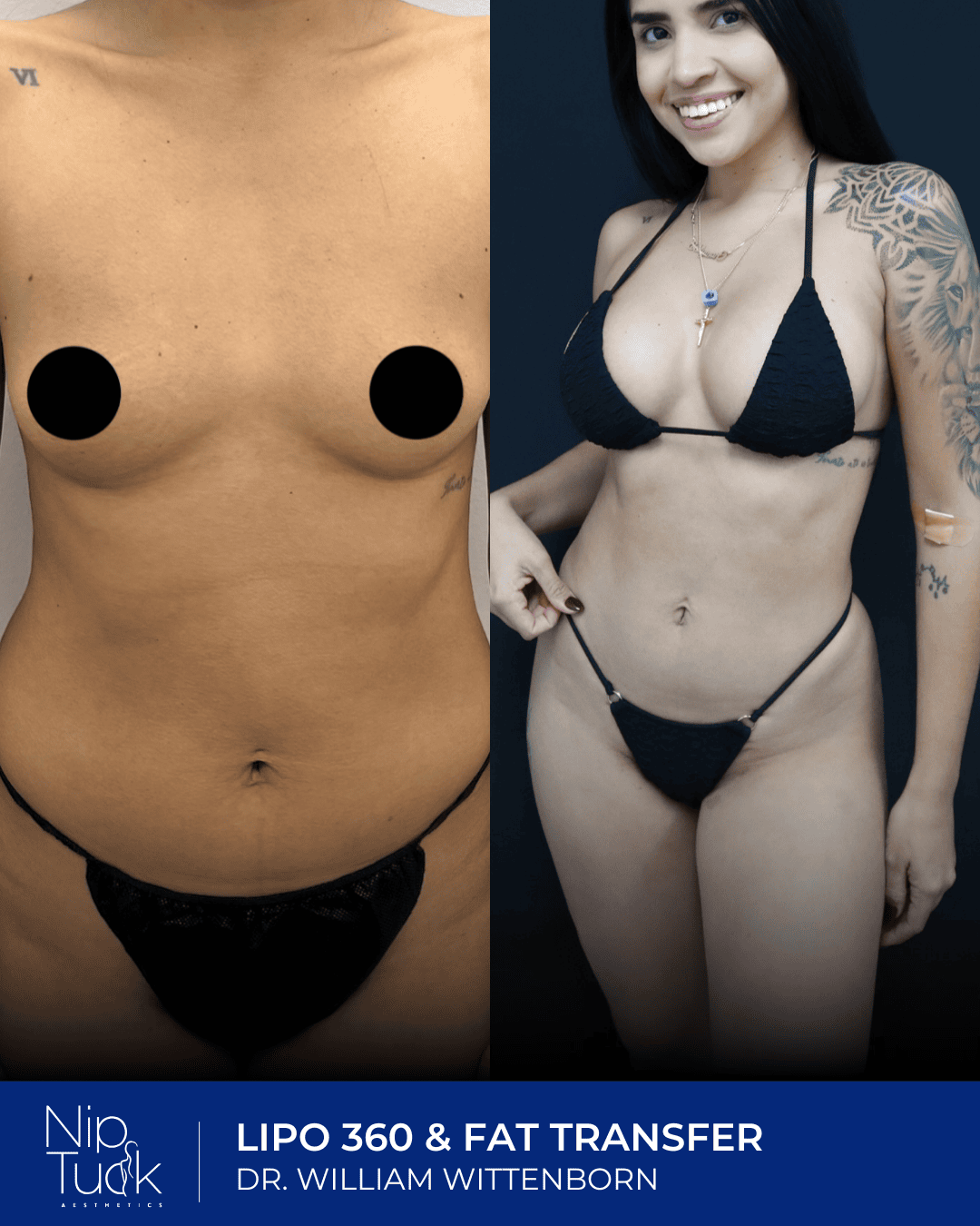 Liposuction results by Dr. Eric Wittenborn
