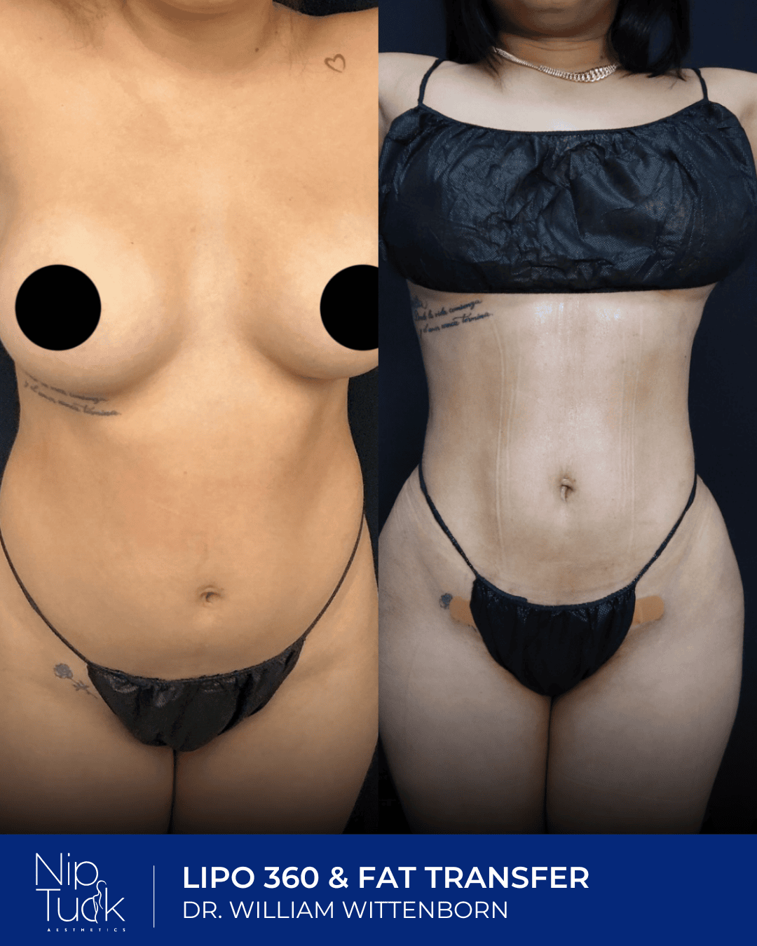 Liposuction results by Dr. Eric Wittenborn